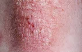 Photo of skin with eczema.