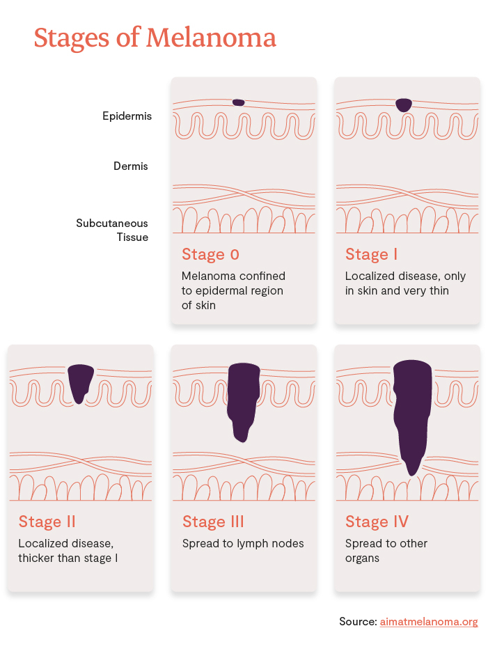 How Long Does It Take For Skin Cancer To Spread