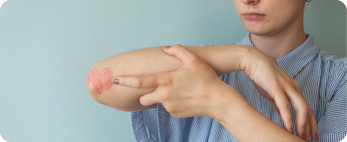 What is Eczema and How Do You Treat it?
