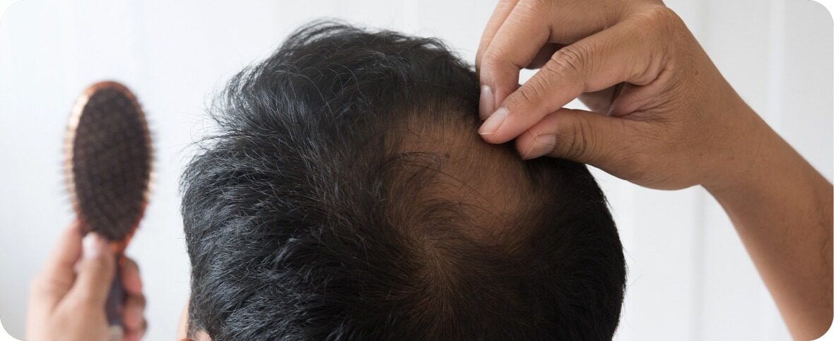 Hair Loss: Causes, Types, and Treatment