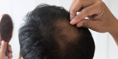 Hair Loss: Causes, Types, and Treatment
