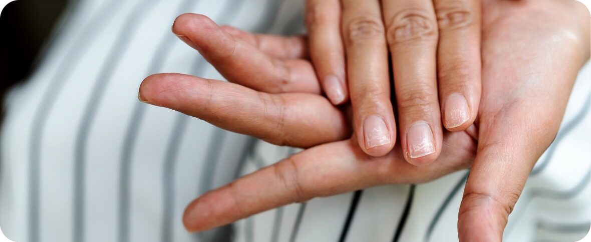 Nail Issues: Causes, Treatment, and Tips