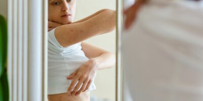 What is Psoriasis? Symptoms, Causes, Treatments, and Medications