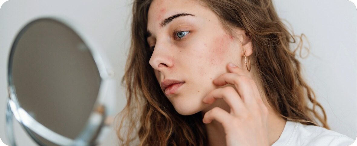 What Causes Rosacea? Treatments, Medications and More