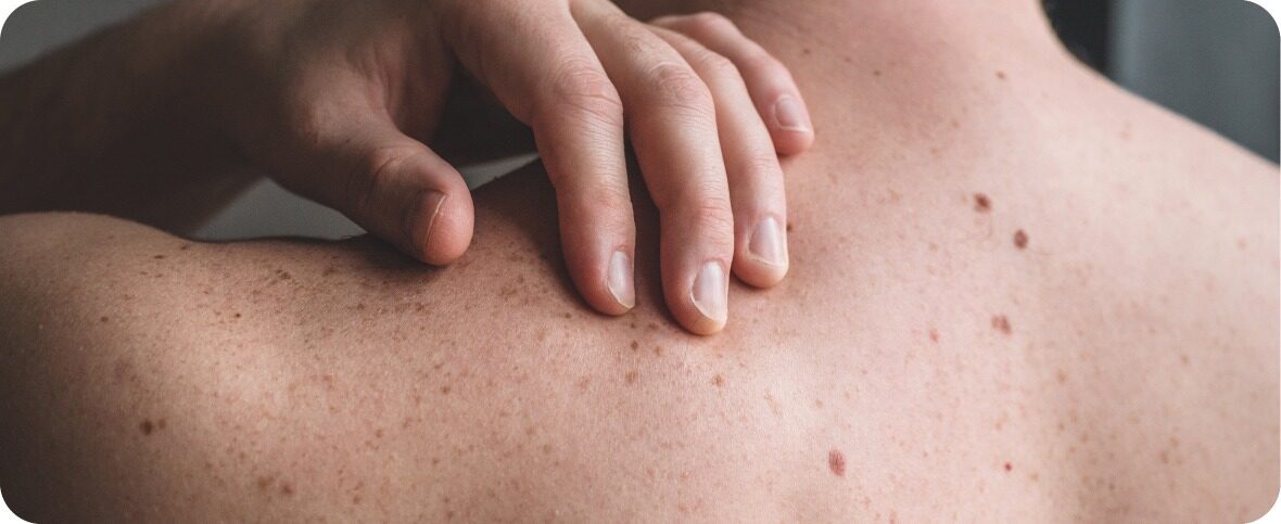 Skin Cancer Symptoms, Causes, and Treatment