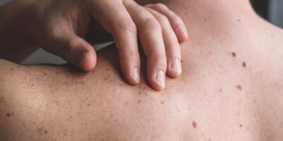 Skin Cancer Symptoms, Causes, and Treatment