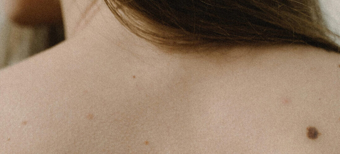 I Got My Moles Mapped, To Try to Prevent Skin Cancer. You Might Want To, Too